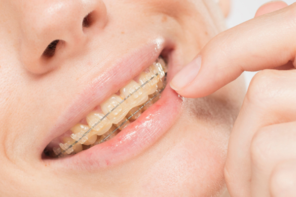 Clear Braces: What Foods Should You Avoid?