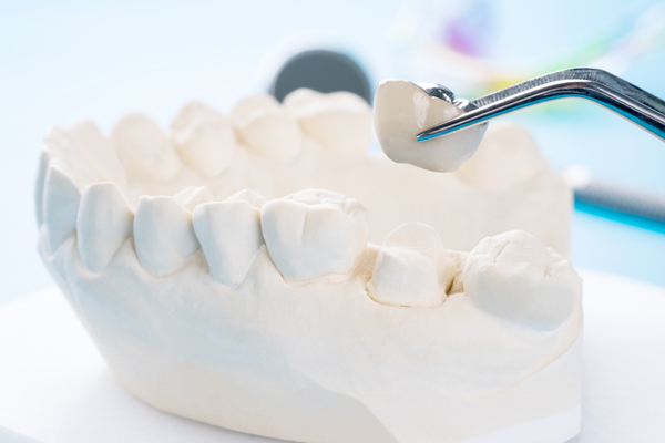 The Steps Of A Dental Crown Restoration