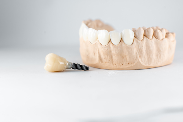 How To Know If You&#    ;re A Candidate For Dental Implants